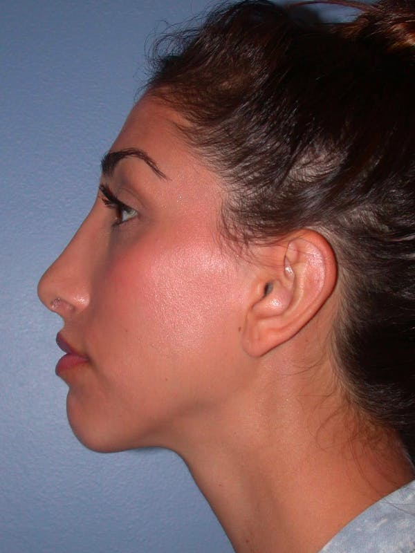 Rhinoplasty Gallery Before & After Gallery - Patient 4757154 - Image 4