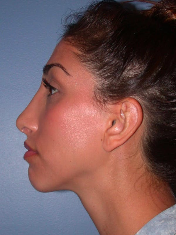 Ear Surgery Gallery Before & After Gallery - Patient 4756991 - Image 4
