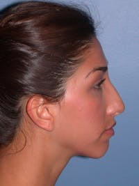 Rhinoplasty Before & After Gallery - Patient 4757154 - Image 1