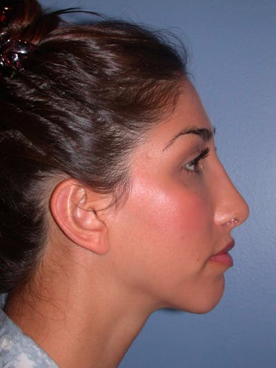 Rhinoplasty Gallery Before & After Gallery - Patient 4757154 - Image 2