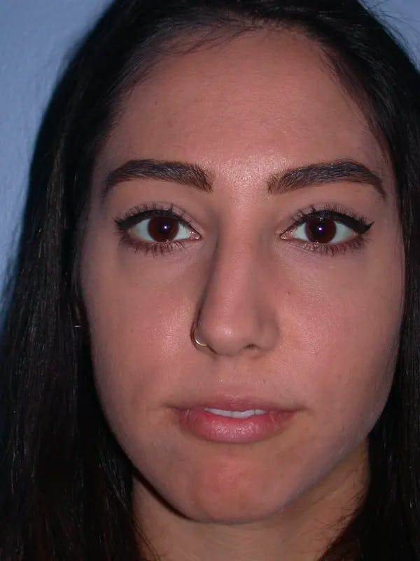Rhinoplasty Before & After Gallery - Patient 4757150 - Image 1