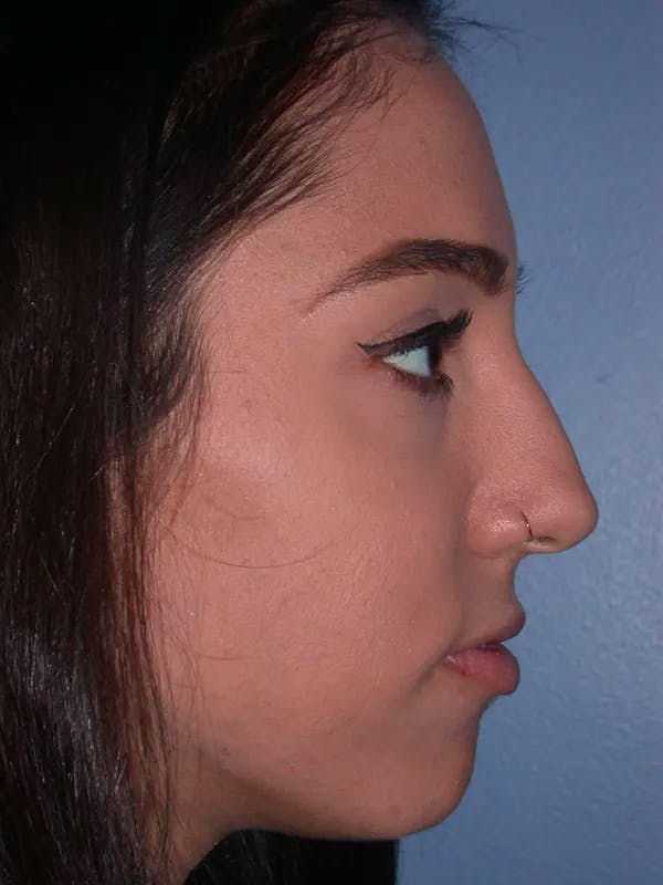 Rhinoplasty Gallery Before & After Gallery - Patient 4757150 - Image 3