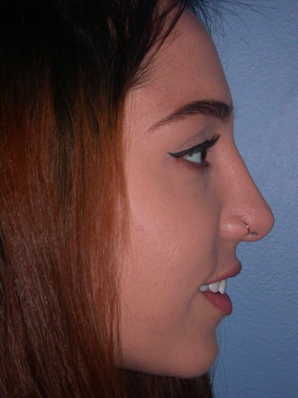 Rhinoplasty Gallery Before & After Gallery - Patient 4757150 - Image 4