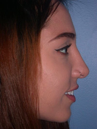 Rhinoplasty Before & After Gallery - Patient 4757150 - Image 4