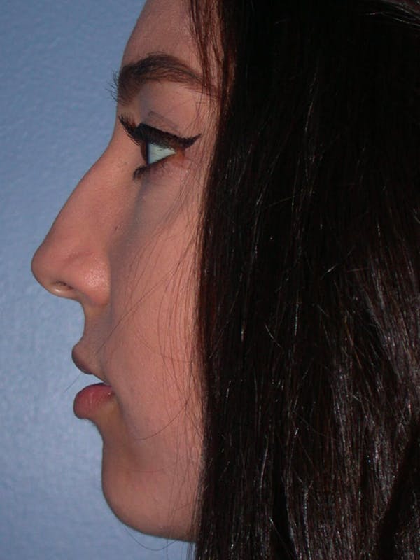 Rhinoplasty Before & After Gallery - Patient 4757150 - Image 5