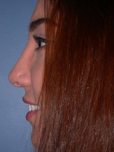 Rhinoplasty Gallery Before & After Gallery - Patient 4757150 - Image 6