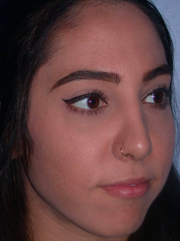 Rhinoplasty Before & After Gallery - Patient 4757150 - Image 7