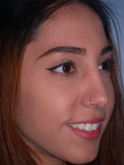 Rhinoplasty Gallery Before & After Gallery - Patient 4757150 - Image 8