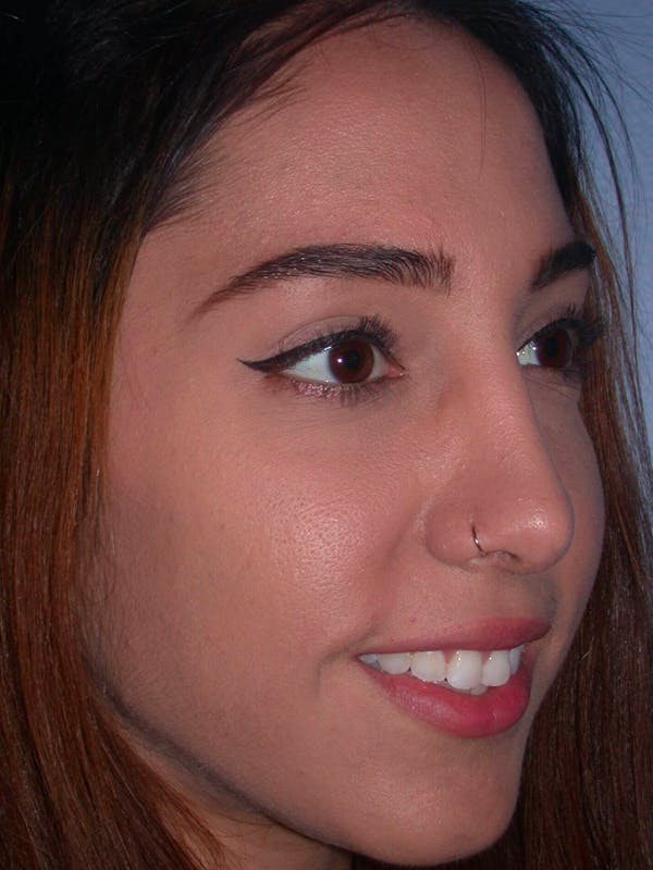 Rhinoplasty Before & After Gallery - Patient 4757150 - Image 8