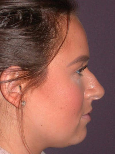 Rhinoplasty Gallery Before & After Gallery - Patient 4757202 - Image 1