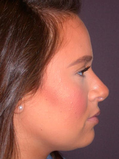 Rhinoplasty Gallery Before & After Gallery - Patient 4757202 - Image 2