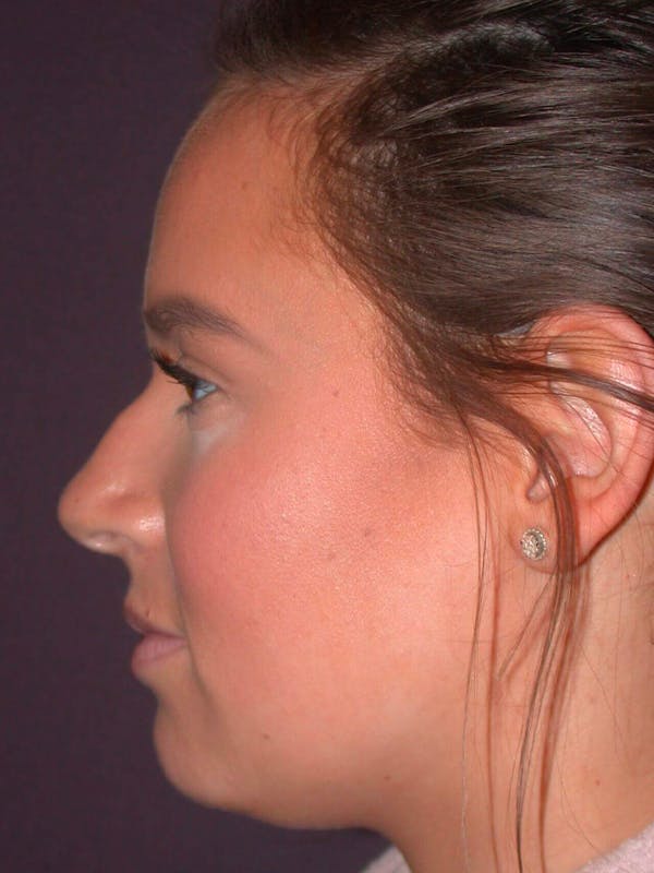 Rhinoplasty Gallery Before & After Gallery - Patient 4757202 - Image 3