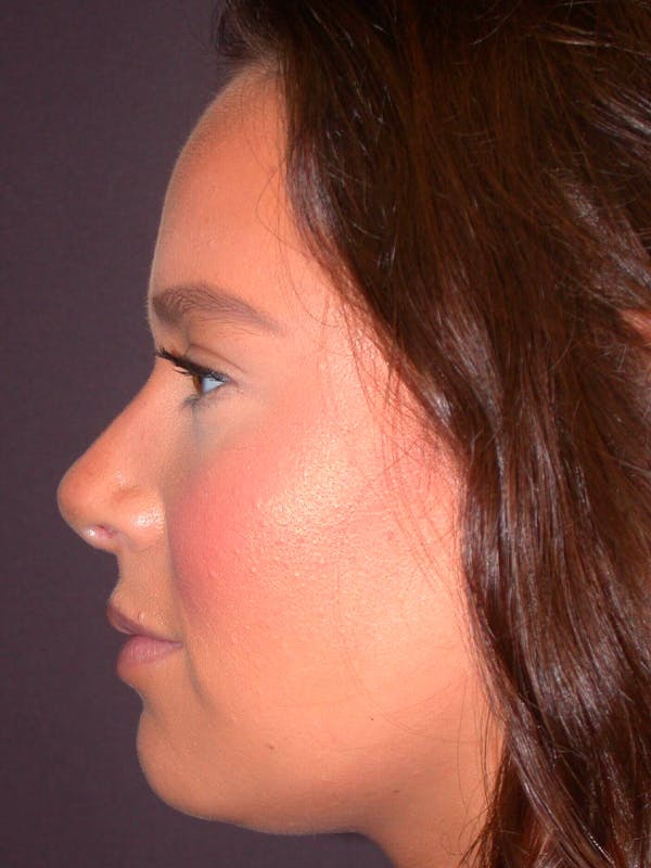 Rhinoplasty Before & After Gallery - Patient 4757202 - Image 4