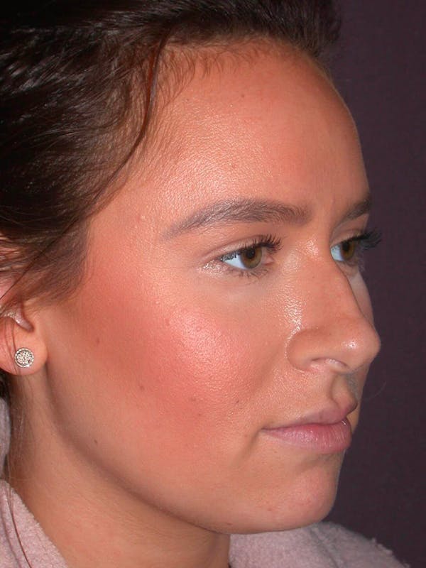 Rhinoplasty Before & After Gallery - Patient 4757202 - Image 5