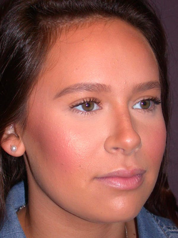 Rhinoplasty Before & After Gallery - Patient 4757202 - Image 6