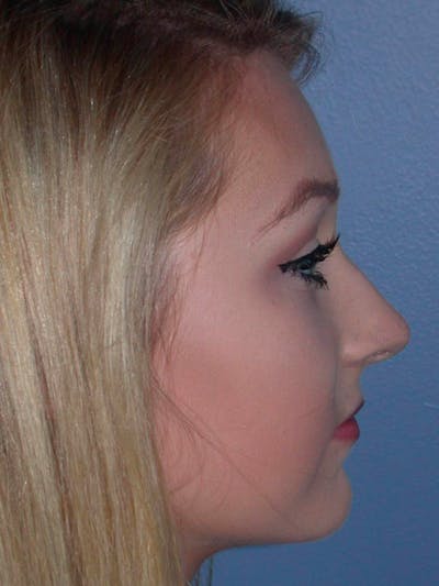 Rhinoplasty Before & After Gallery - Patient 4757159 - Image 1