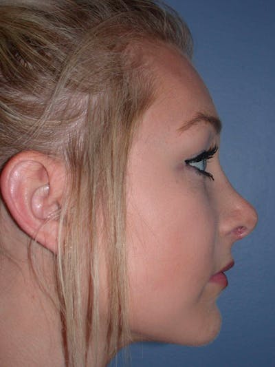 Rhinoplasty Gallery Before & After Gallery - Patient 4757159 - Image 2