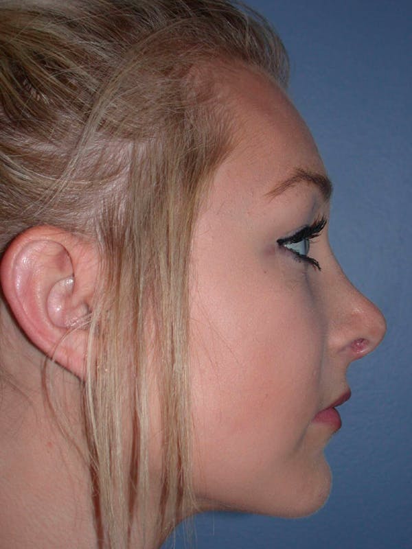 Rhinoplasty Before & After Gallery - Patient 4757159 - Image 2
