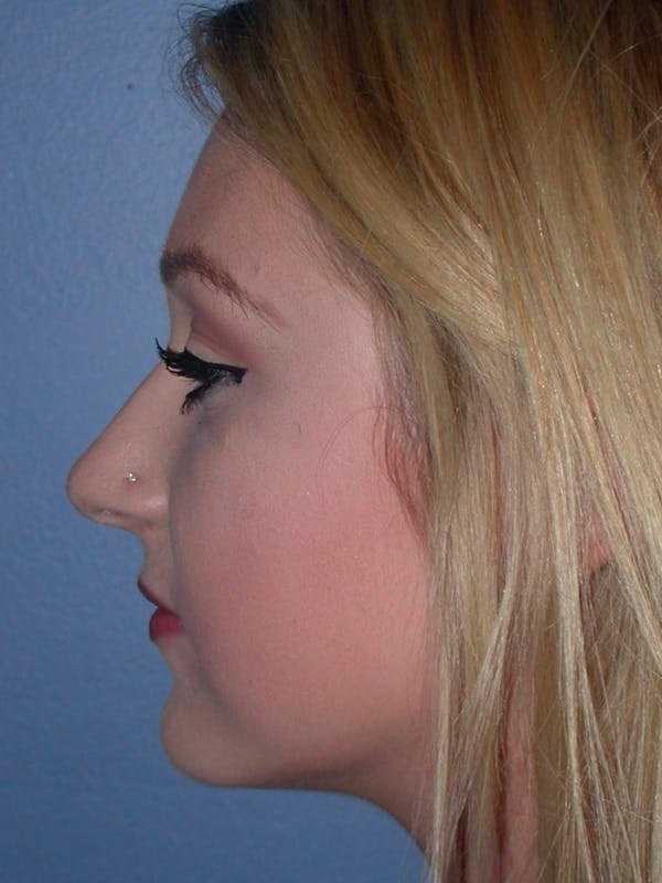 Rhinoplasty Gallery Before & After Gallery - Patient 4757159 - Image 3