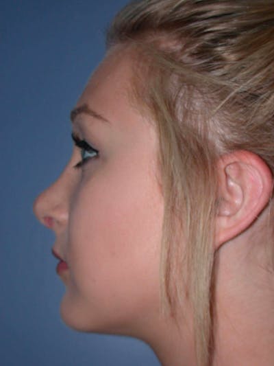 Rhinoplasty Gallery Before & After Gallery - Patient 4757159 - Image 4