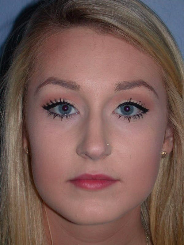 Rhinoplasty Before & After Gallery - Patient 4757159 - Image 5