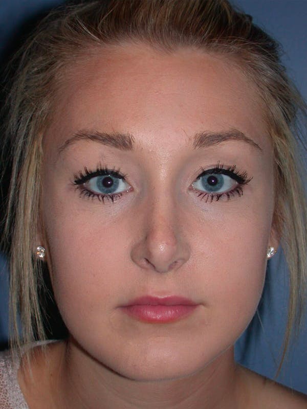 Rhinoplasty Gallery Before & After Gallery - Patient 4757159 - Image 6