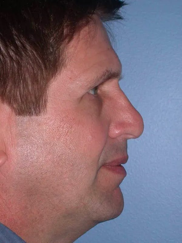 Revision Rhinoplasty Gallery - Patient 4757182 - Image 3