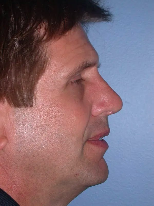 Revision Rhinoplasty Gallery - Patient 4757182 - Image 4