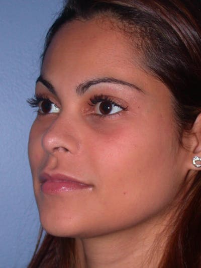 Revision Rhinoplasty Gallery - Patient 4757186 - Image 4