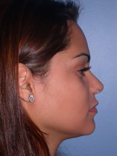 Revision Rhinoplasty Gallery - Patient 4757186 - Image 6