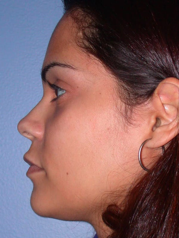 Revision Rhinoplasty Gallery - Patient 4757186 - Image 7