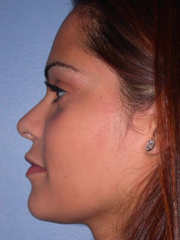 Revision Rhinoplasty Gallery - Patient 4757186 - Image 8