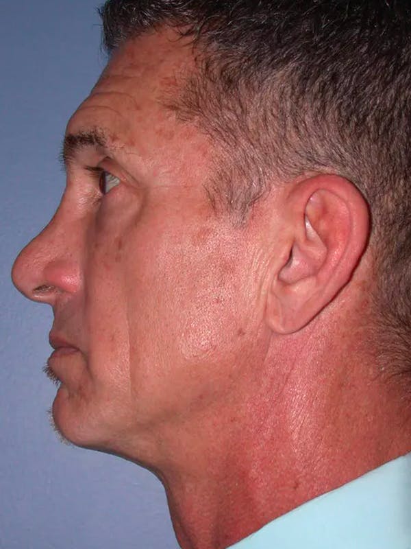 Facial Fat Grafting Gallery Before & After Gallery - Patient 4757178 - Image 3