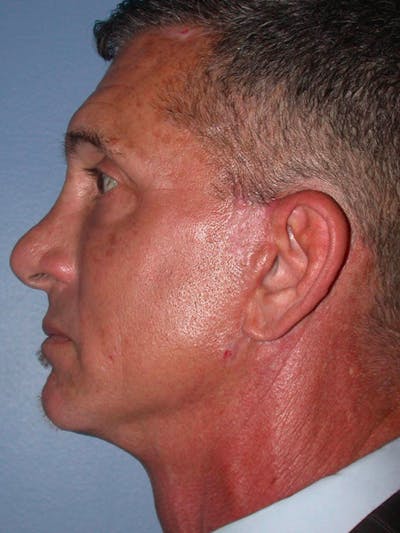 Facial Fat Grafting Gallery Before & After Gallery - Patient 4757178 - Image 4