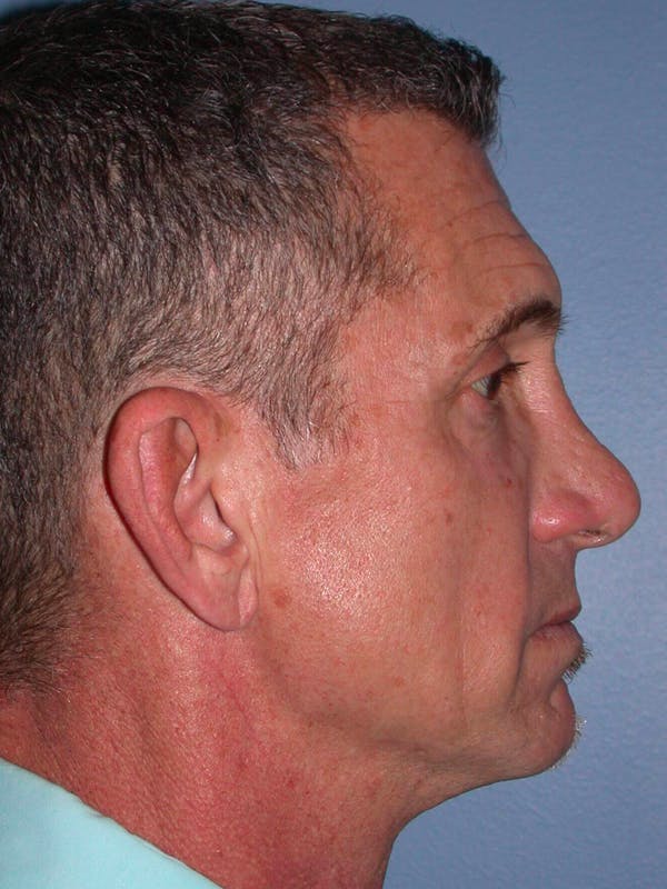 Facelift Before & After Gallery - Patient 4757014 - Image 5