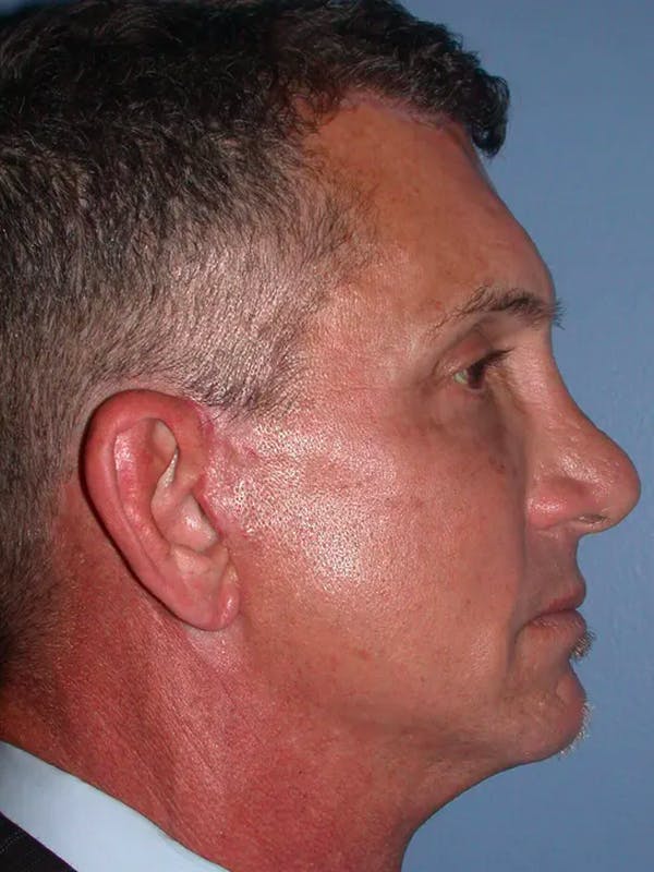 Facial Fat Grafting Gallery Before & After Gallery - Patient 4757178 - Image 6