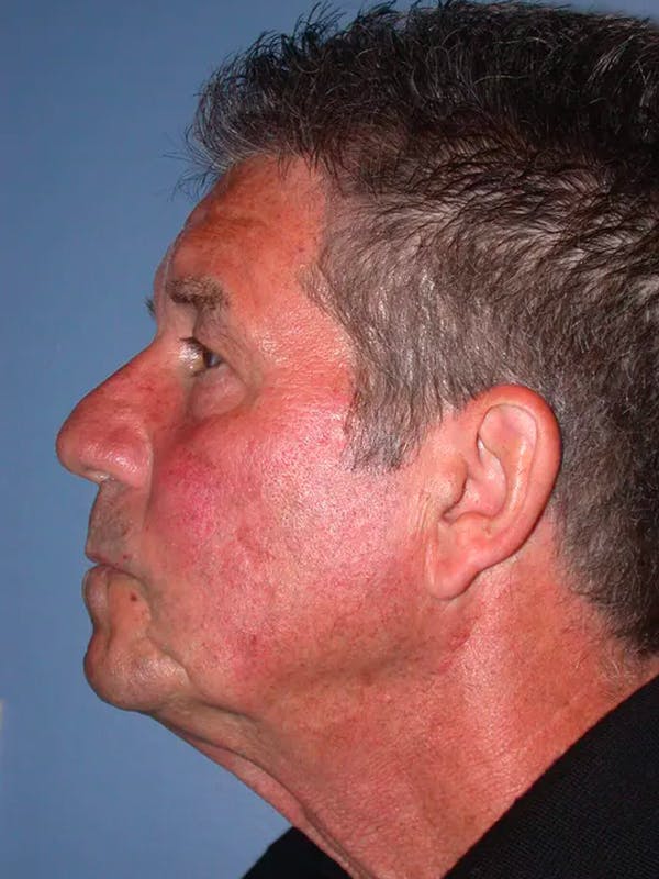 Facial Fat Grafting Before & After Gallery - Patient 4757175 - Image 3