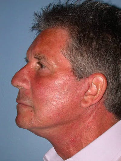 Facial Fat Grafting Gallery Before & After Gallery - Patient 4757175 - Image 4