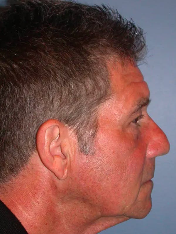 Facial Fat Grafting Before & After Gallery - Patient 4757175 - Image 5