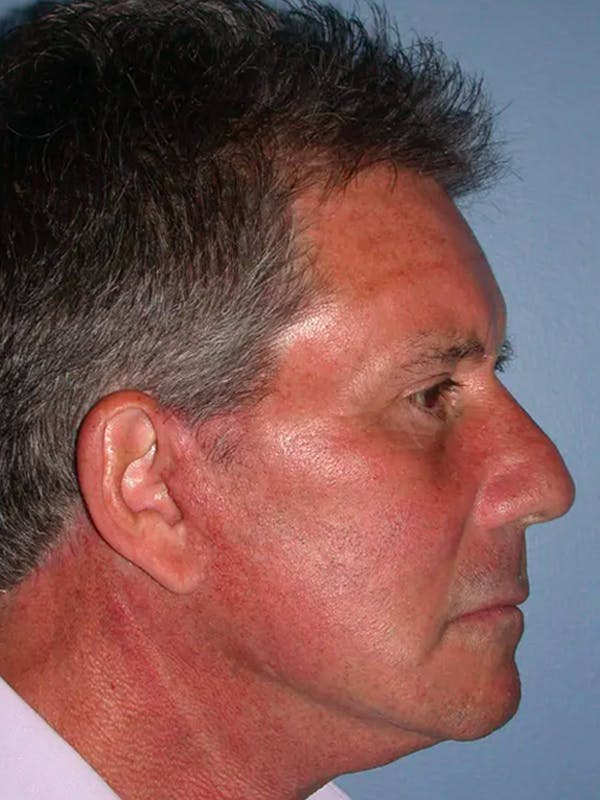 Neck Lift Before & After Gallery - Patient 4757164 - Image 6