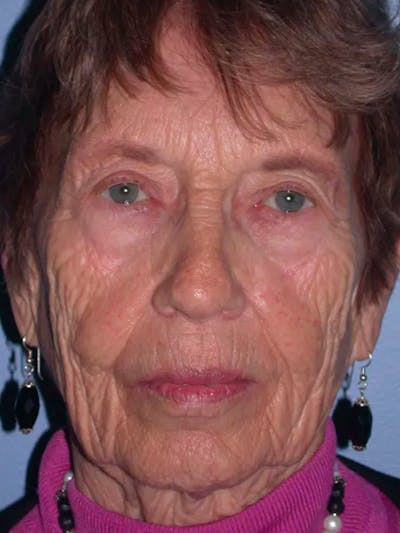 Facelift Gallery Before & After Gallery - Patient 4756977 - Image 1