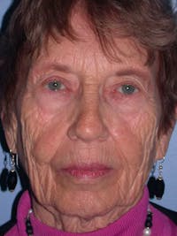 Facelift Before & After Gallery - Patient 4756977 - Image 1
