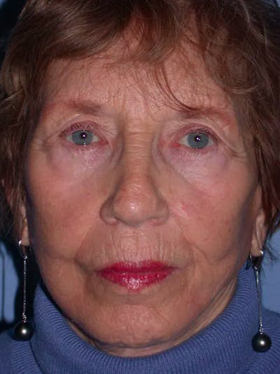 Facelift Gallery Before & After Gallery - Patient 4756977 - Image 2