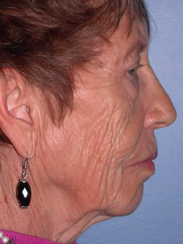Facelift Before & After Gallery - Patient 4756977 - Image 3