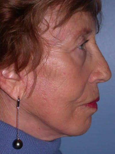 Facelift Before & After Gallery - Patient 4756977 - Image 4