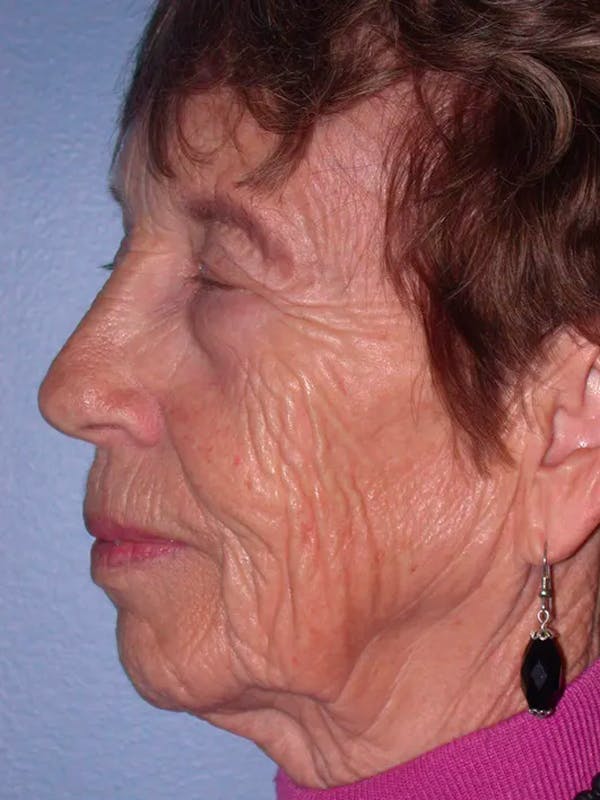 Facelift Before & After Gallery - Patient 4756977 - Image 5