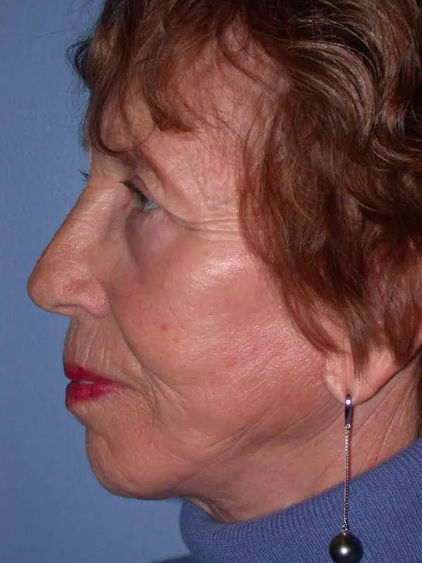 Facelift Gallery Before & After Gallery - Patient 4756977 - Image 6