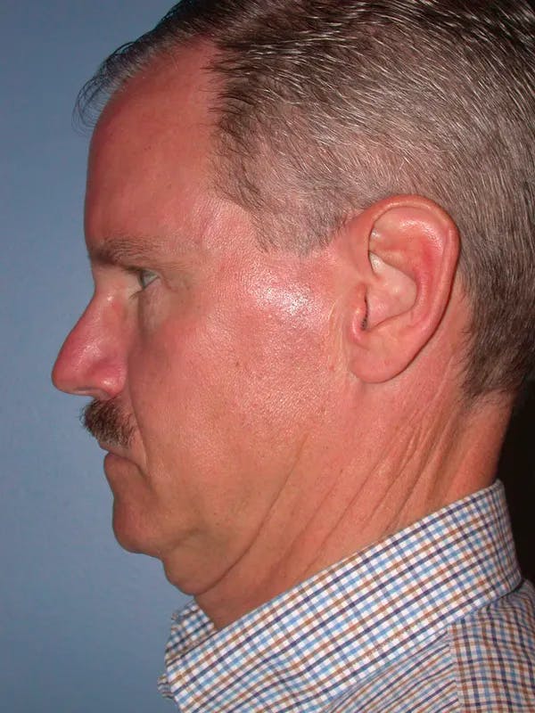 Facelift Gallery Before & After Gallery - Patient 4757015 - Image 3