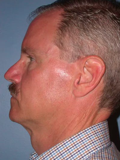 Facelift Before & After Gallery - Patient 4757015 - Image 4
