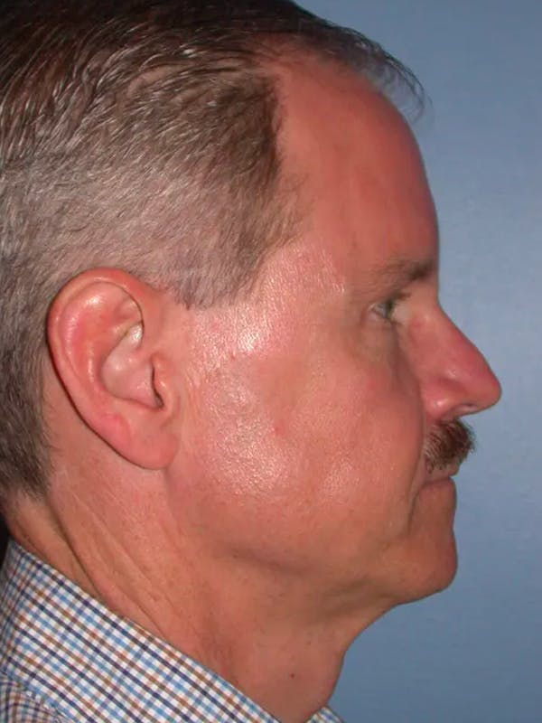 Facelift Gallery Before & After Gallery - Patient 4757015 - Image 5